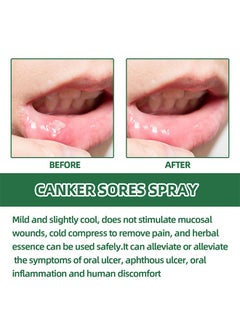SOUTH MOON Canker Sore Treatment Spray 20ml，Herbal Ulcer Treatment,Natural Mouth Sore Relief for Daily Oral Care, Mouth Spray,Treat Mouth Ulcer,Effective Mouth Sore Treatment  - Image 3