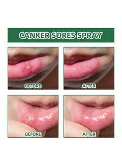 SOUTH MOON Canker Sore Treatment Spray 20ml，Herbal Ulcer Treatment,Natural Mouth Sore Relief for Daily Oral Care, Mouth Spray,Treat Mouth Ulcer,Effective Mouth Sore Treatment  - Image 5