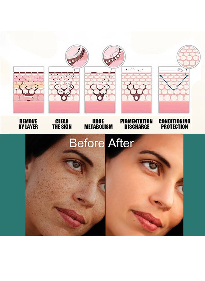 EELHOE - Whitening Freckle Cream,Pigmentation Removal Cream for Face,Freckle Remover Cream,Moisturizing Anti-blemish Cream,Dark Spots Remover Skin Whitening 30g - Image 1