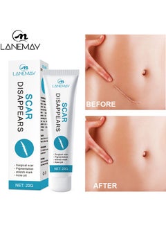 Scar Cream, Medical Grade Silicone Scar Cream Advanced Scar Removal Gel For Surgical Scars Stretch Marks Acne Injury Burns Keloids Hypertrophic Old And New Scars 20G