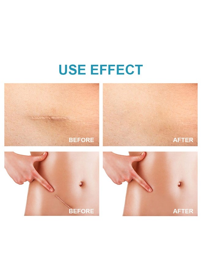 LANEMAY - Scar Cream, Medical Grade Silicone Scar Cream Advanced Scar Removal Gel For Surgical Scars Stretch Marks Acne Injury Burns Keloids Hypertrophic Old And New Scars 20G - Image 1