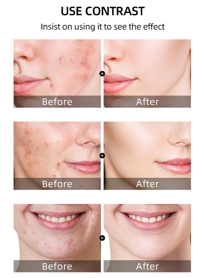 MOOYAM 2 Pcs Salicylic Acid Remove Acne Gel, Rapid Action Acne Spot Treatment for Face Closure & Acne Dots, Premium Acne Scar Gel & Pimple Remover, 20g  - Image 5