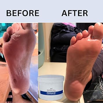 Marble Hill PediSalve Foot Cream Fast Relief Very Dry Feet Hard Skin Cracked Heels Diabetic Foot Care Eczema Shea butter Vit E Developed by Medical Doctor Marble Hill 400g - Image 4