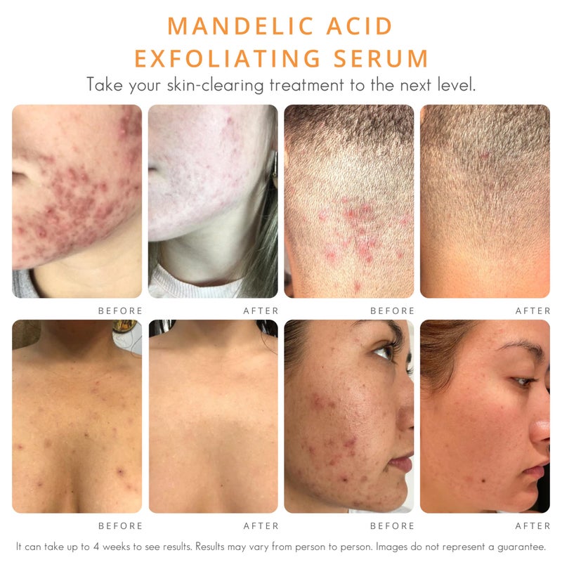Almond Clear Level 1 Serum | Mandelic Acid Facial Serum for Acne, Folliculitis, Aging Skin, Ingrown Hairs, Dark Spots on Face, Chest, Butt, Back, Thighs, Arms | 4oz - Image 3
