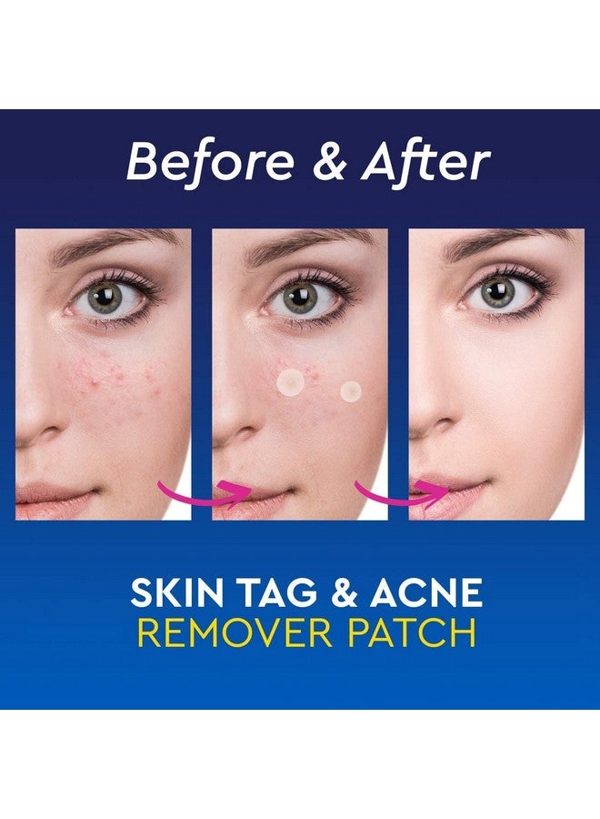 BLAGO Acne Pimple Patches For Face, Hydrocolloid Dressing Cover, Dots for Spots Pimple Patches, Effectively Calms & Relieves Acne, Facial Care, Complete Pimple Remover (72 Pcs) - Image 3