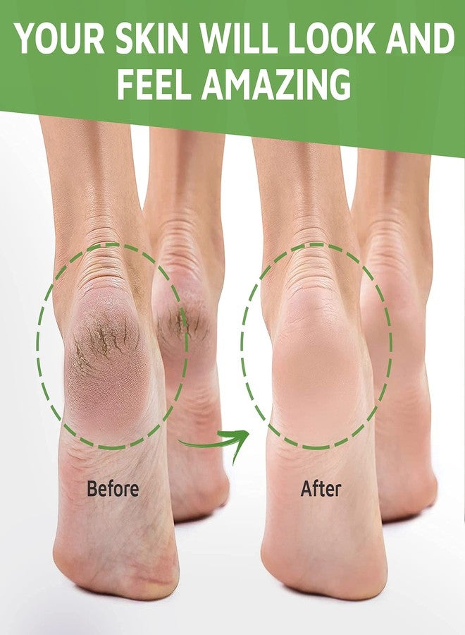 Activelife - Urea Cream 40 Percent for Feet, Formulated by Doctors, Foot Cream for Dry Cracked Heels, Foot Callus Remover, Rehydrates Dry, Rough, Dead Skin on the Feet, Hands, and Elbows, Free Pumice - Image 2