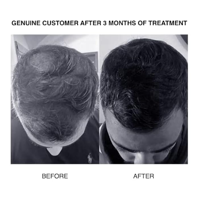 PATRICKS | SH PLUS Ultra Thickening Shampoo for Hair Loss in Men | DHT Blocker | Includes Castor Oil & Other Powerful Ingredients to Support Hair Growth | For Moderate to Advanced Hair Loss | 200mL - Image 3