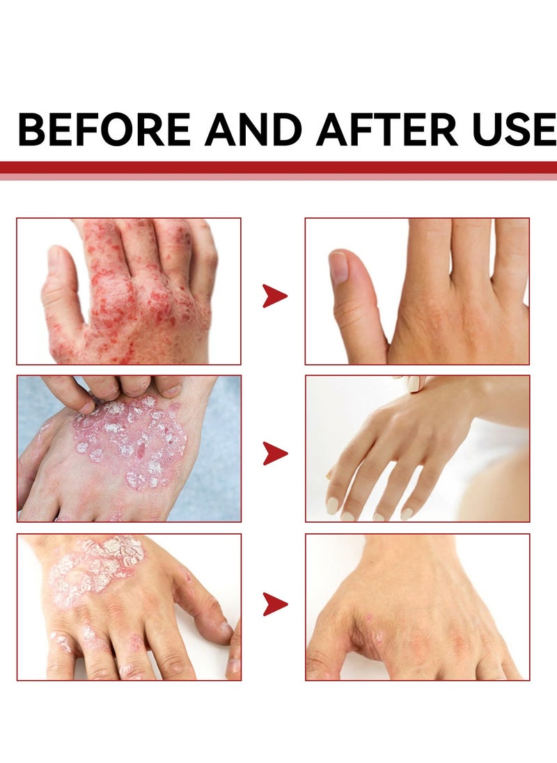 SOUTH MOON - Eczema and Psoriasis Atomizing Creams ，Natural Chinese Herbal Eczema Psoriasis Creams，Treatment Psoriasis Eczema Cream ，Antibacterial Antipruritic Dermatitis Herbal Ointment，Anti-itch Medical Plaster - Image 1