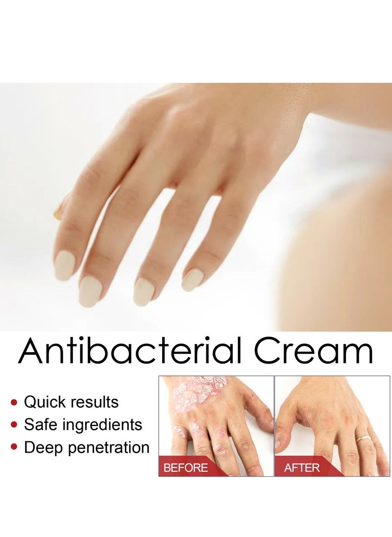 SOUTH MOON - Eczema and Psoriasis Atomizing Creams ，Natural Chinese Herbal Eczema Psoriasis Creams，Treatment Psoriasis Eczema Cream ，Antibacterial Antipruritic Dermatitis Herbal Ointment，Anti-itch Medical Plaster - Image 1