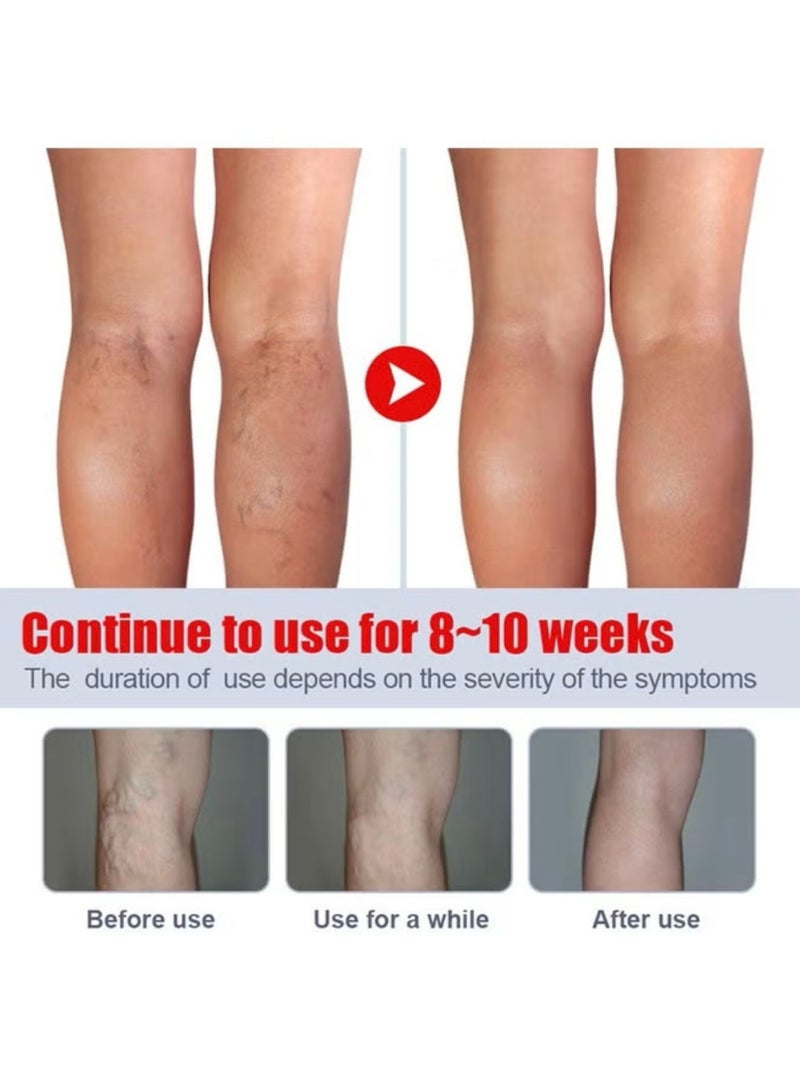 KanyeHB Varicose Veins Remove Cream 20g, Blood Circulation Vein Care Leg Cream, Vasculitis Phlebitis Foot Care Ointment, Pain Relief Therapy Firming Vein Lotion - Image 3