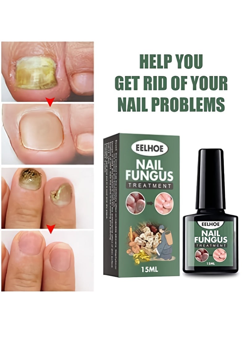 EELHOE Fungal Nail Liquid, Anti Fungal Nail Treatment Nail Care Solution, Anti-infection Fungus Removal Liquid, Safe Ginger-nail Fungal Treatment For Hand And Toe Nails - Image 4