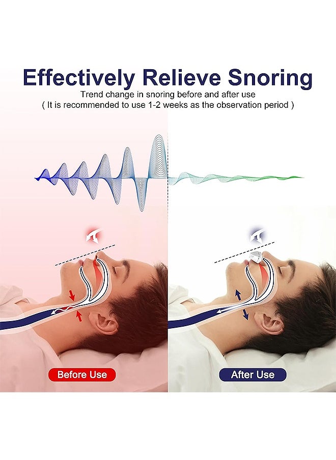 Anti Snoring Device, Adjustable Wind Speed Electric Nasal Soothing Device, Effective Snoring Prevention for Men and Women (White)