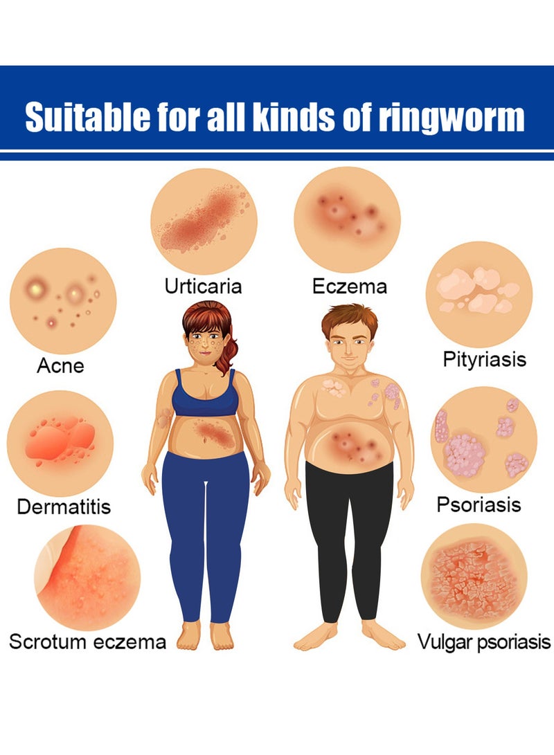 ساوث مون 2-Packs Psoriasis cream,External skin ointment, antibacterial ointment 20g*2 - Image 5