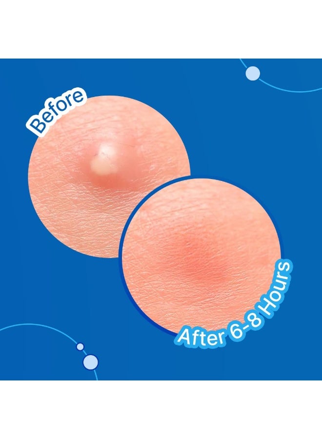 So True Sotrue Acne Pimple Patches For Face | For Active Surface Acne | Hydrocolloid Waterproof Patches | Absorbs Pimple Overnight, Reduces Excess Oil | Suits All Skin Types (36 Patches) - Image 3