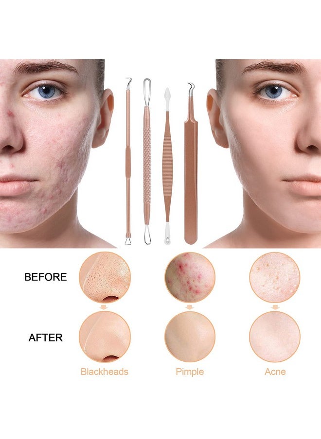 MENOLY - Pimple Popper Tool Kit Menoly 10 Pcs Blackhead Remover Comedone Extractor Acne Removal Kit For Blemish Whitehead Poppingzit Removing For Nose Face Tools With A Leather Bag (Rose Gold) - Image 1