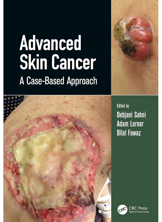 Advanced Skin Cancer: A Case-Based Approach