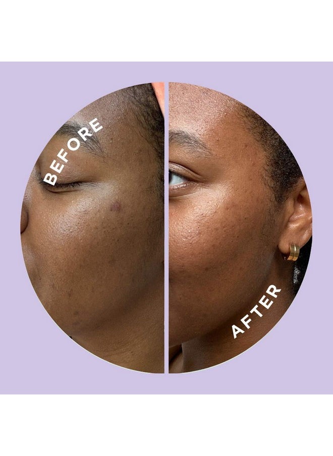 Hyperfade Acne Patches For Face World'S Most Potent Pimple Patch With Fastacting Microdarts Starts Working Within 2 Hours For Deep Earlystage Zits & Blemish 12 Count