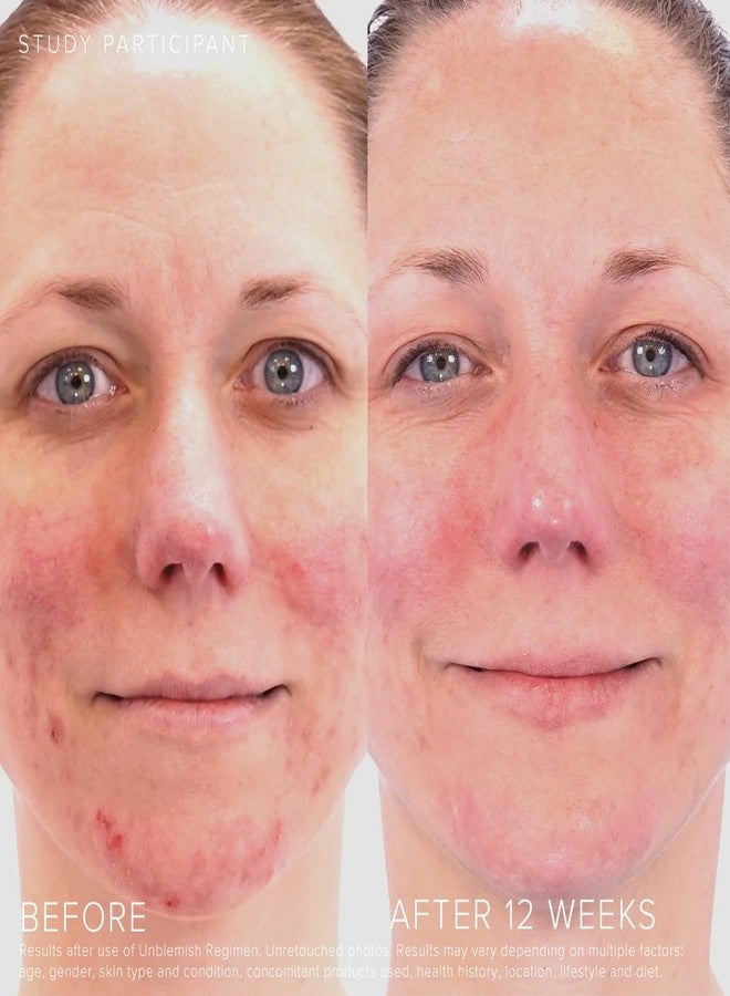 Rodan Fields Rodan + Fields Unblemish Dual Intensive Acne Treatment | 0.76 Fl Oz | Targets Blemishes | Benzoyl Peroxide & Ceramides - Image 3