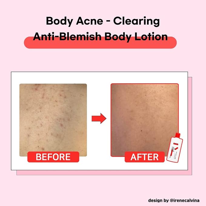 TIA'M TIAM Anti-Blemish Body Lotion, Body Acne Treatment, bacne, Great for fighting breakouts and acne scars removal, 6.76 OZ - Image 3