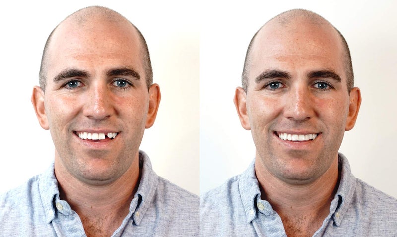 Instant Smile Triple Shade Temporary Tooth Kit - Replace A Missing Tooth in Just 5 Minutes! - Image 1