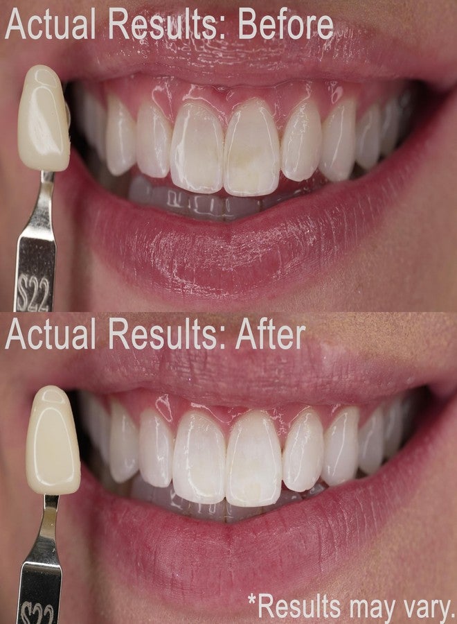 EZZI Teeth Whitening Kit | Fast Whitener Gel 44% Carbamide Peroxide | for Discolored, Yellow, Brown, Black, Coffee, Smoking, Intrinisic Deep Stains - Image 2