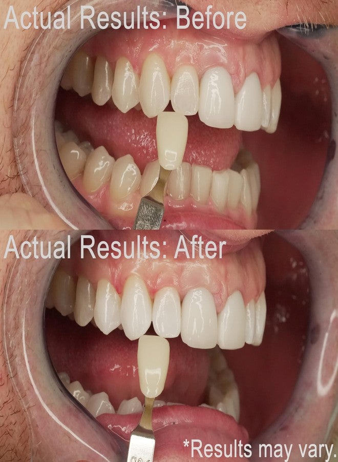 EZZI Teeth Whitening Kit | Fast Whitener Gel 44% Carbamide Peroxide | for Discolored, Yellow, Brown, Black, Coffee, Smoking, Intrinisic Deep Stains - Image 3