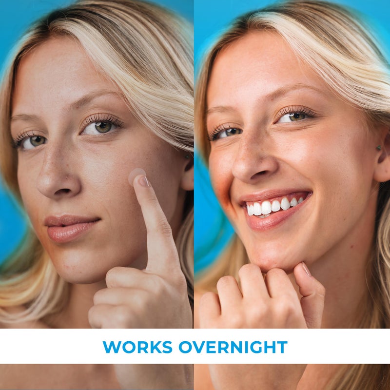 KEYCONCEPTS PatchRx Pimple Patches for Face (240 Patches), Hydrocolloid Acne Patches with Tea Tree Oil, Pimple Patch Pimple Stickers - Hydrocolloid Patch Acne Dots - Acne Pimple Patches For Face - Zit Patches - Image 5