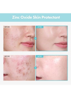 Tosowoong TOSOWOONG SOS Repair CICA Clinic Zinc Cream, 100,000ppm Zinc Oxide, Heal and Soothe Acne, Skin Barrier Repair, Moisture Barrier Cream, Non-Comedogenic, Korean Skincare, 50g, 1.76 oz.  - Image 2