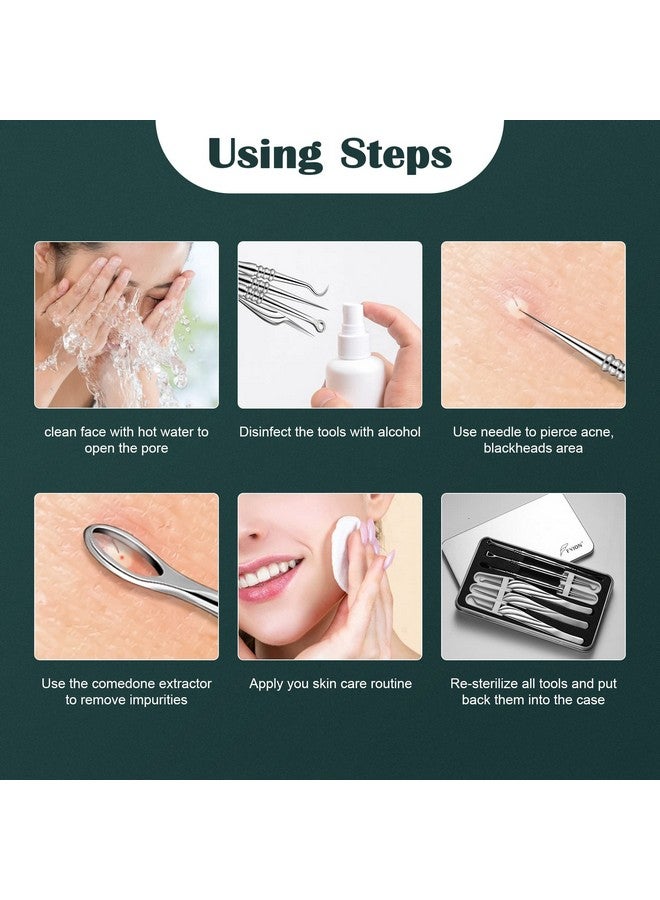 FVION Blackhead And Acne Extractor Kit Professional Pimple Popper Tool Kit Acne Tweezers And Blackhead Remover Tools For Face 6 Pcs Surgical Extractor Pimple Popping Tools - Image 5