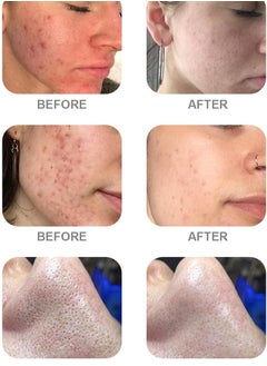 AS AS1 SA2 AO3 Aqua Peeling Solution Premium Salon Professional Dermabrasion Serum for Small Bubble Skin Care Facial Mask Machine (AS1 SA2 AO3, 3*400ml)  - Image 5