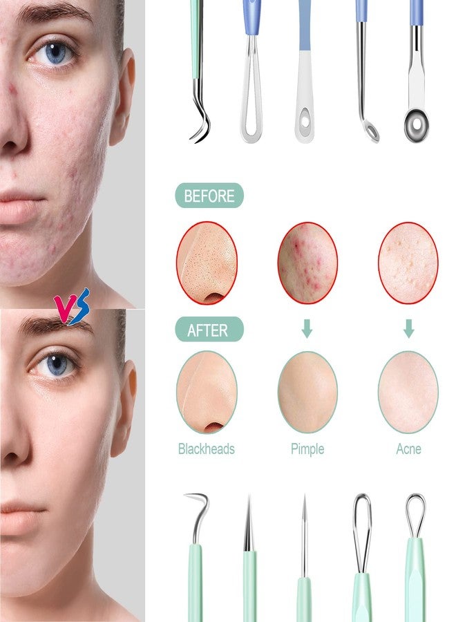 MENOLY Blackhead Remover Tools MENOLY 10Pcs Pimple Popper Tool Kit, Blackhead Remover Extractor Tools, Acne Kit for Blackhead,Blemish,Zit Whitehead and Comedone Extractor Tool with Leather Bag - Image 3