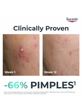 Dermo Purifyer Post - Blemish Marks Reduction, 40ml - Packaging May Vary - view 2