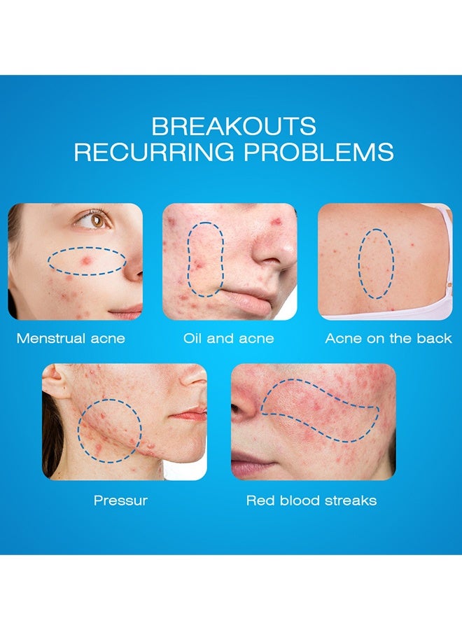 سوميفون كريم Expigment بنسبة 4%، للتحكم الدقيق في حب الشباب للوصول إلى جذور الحبوب - Image 5