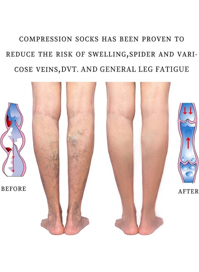 Therapeutic Compression Socks - 20-30 mmHg - Open Toe Stockings for Varicose Vein & Swollen Legs Relief - Practical Daily Use - Image 4