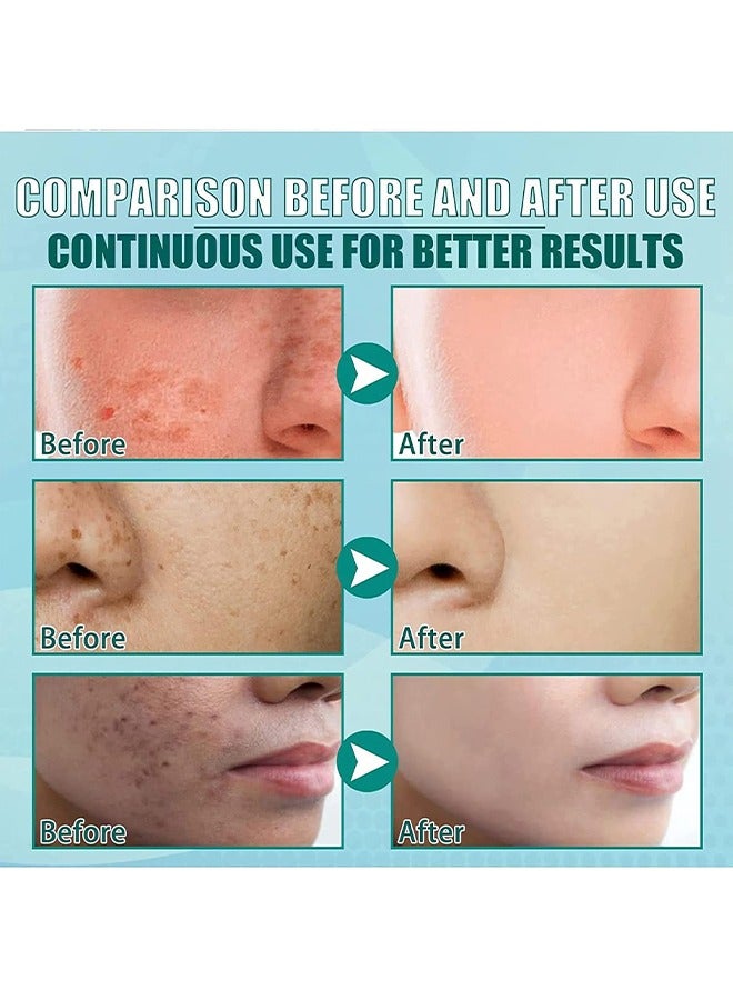 Beauenty White Spot Cream, Whitening Freckle Cream Remove Melasma Cream, Dark Spot Remover For Face Hyperpigmentation Treatment, Dark Spot Corrector For Face, Smooth Skin Moisturizer Cream 50G  - Image 5