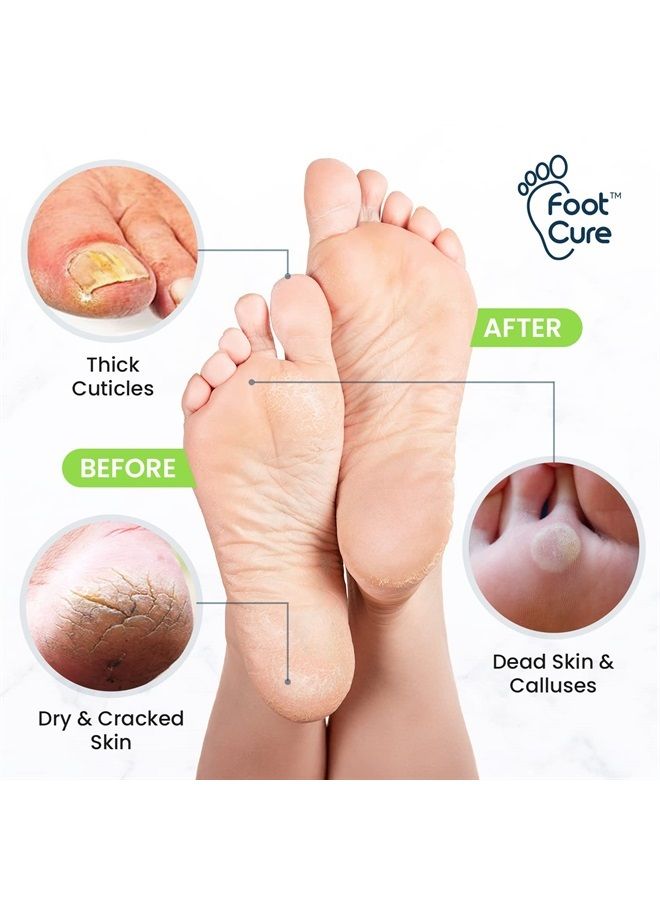 Foot Cure Tea Tree Foot Soak & Callus Remover Gel Kit - Extra Strength Callus Remover Gel & Foot Soak With Epsom Salts For Calluses, Dry Cracked Heels, Toenail - Pedicure for Tired Feet - Image 1