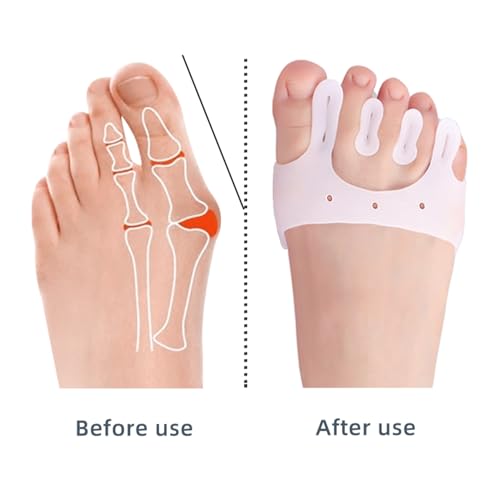 JSHshield Toe SpacersToe SeparatorSpreaders StraightenersMetatarsal PadsBunion Corrector for Women MenOverlapping Hammer Toe SpacersRelieve Foot Pain Correct Toes - Image 3