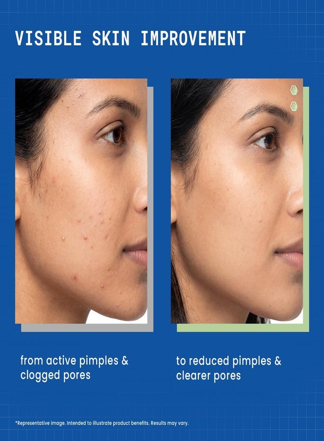DERMDOC 2% Salicylic Acid w/w Pimple Gel, 5ml | Acne Spot Treatment for Oily & Acne-Prone Skin | Reduces Pimples, Redness & Inflammation | Clears Clogged Pores | Lightweight & Fast Absorbing | Anti-Acne Gel for Breakouts & Active Pimples - Image 2