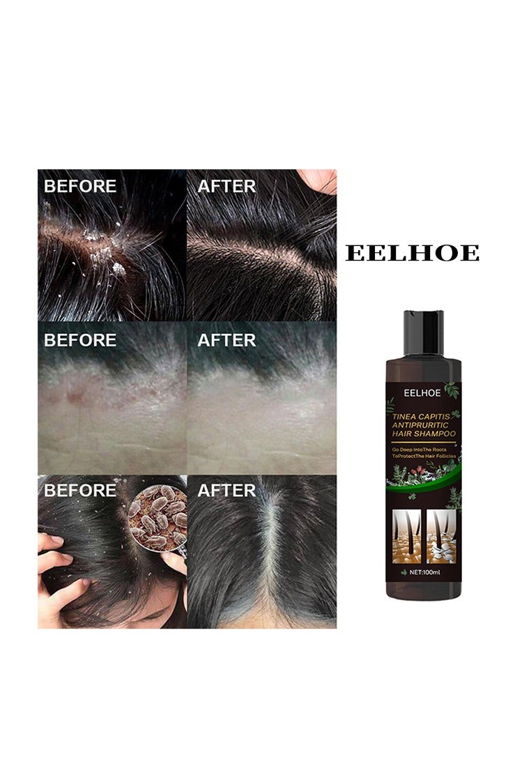 EELHOE Tinea Capitis Antipruritic Hair Shampoo- Deep Clean Safe Gentle Effective Professional Anti-Dandruff Remove Mites and Relieve Itching Natural Extract Anti Hair Loss 100ml - Image 1