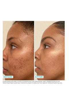 Urban Skin Rx Urban Skin Rx® Even Tone Cleansing Bar | 3-in-1 Daily Cleanser, Exfoliator, and Brightening Mask Helps Diminish Uneven Skin Tone, Formulated with Kojic Acid, Azelaic Acid, and Niacinamide | 2.0 Oz  - Image 4
