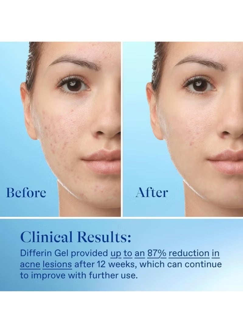 ديفرين جل لعلاج حب الشباب، يكفي لمدة 60 يومًا، علاج بالريتينويد للوجه مع 0.1% أدابالين، عناية لطيفة بالبشرة الحساسة المعرضة لحب الشباب، 15 غرامًا - Image 5