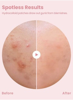Glam Up Hydrocolloid Blemish Pimple Zit Patches - Invisible Ultra Thin Spot Cover Stickers for Face and Skin, Strong Water-proof and Adhesive Overnight, Vegan-friendly (144 Count / 2 Sizes)  - Image 3