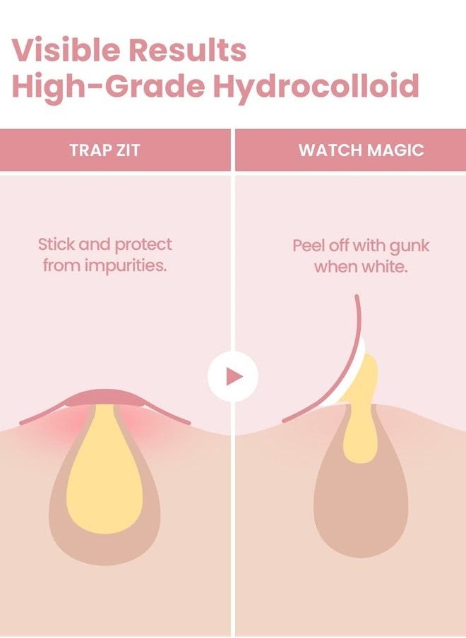 Glam Up - Hydrocolloid Blemish Pimple Zit Patches - Invisible Ultra Thin Spot Cover Stickers for Face and Skin, Strong Water-proof and Adhesive Overnight, Vegan-friendly (144 Count / 2 Sizes) - Image 1