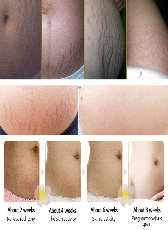 MQUPIN UniM Mango Stretch Marks and Scar Cream -Stretch Marks and Scar Removal Cream for Pregnancy - Best Body Moisturizer-40g - Image 3