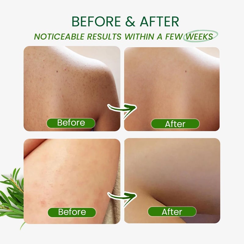 PHARMBANNER Tea Tree Antifungal Body Wash â€“ Soothes Folliculitis, Acne, Jock Itch, Athleteâ€™s Foot, Ringworm, Tinea Versicolor, Body Odor, Eczema & Dermatitis-Prone Skin - Image 5