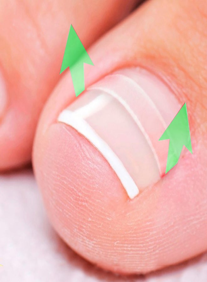 Ingrown Toenail Correction Set Toenail Treatment Toenail Straightening Patch Pusher Recover Tool Foot Care Kit - Image 2