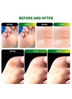 Sumifun 54 Pcs Foot Corn Removal Plaster,Natural Ingredients,Foot Care Expert,Calluses Plantar Treatment,Relief Pain From Calluses, Corns, Blisters, Heel Frictions  - Image 4