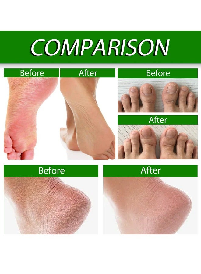 EELHOE Allantoin 40% Cream For Cracked,Rough Thick and Dry Skin Soothes and Softens Feet,Elbows and Knees Hydrating and Moisturizing Foot Care Cream 100g - Image 5