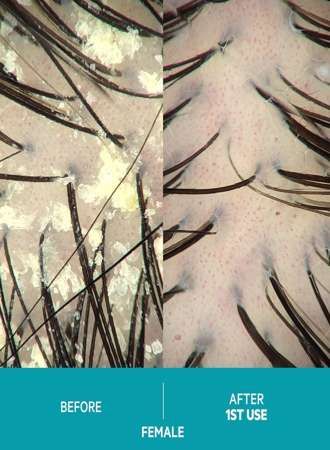 DS LABORATORIES DS Labs Dandrene Dandruff Conditioner - for Itchy, Flaky Scalp, Moisturizing Conditioner with Aloe Vera, Supports Scalp Health & Oil Control, For Seborrheic Dermatitis & Psoriasis, 205mL - Image 3