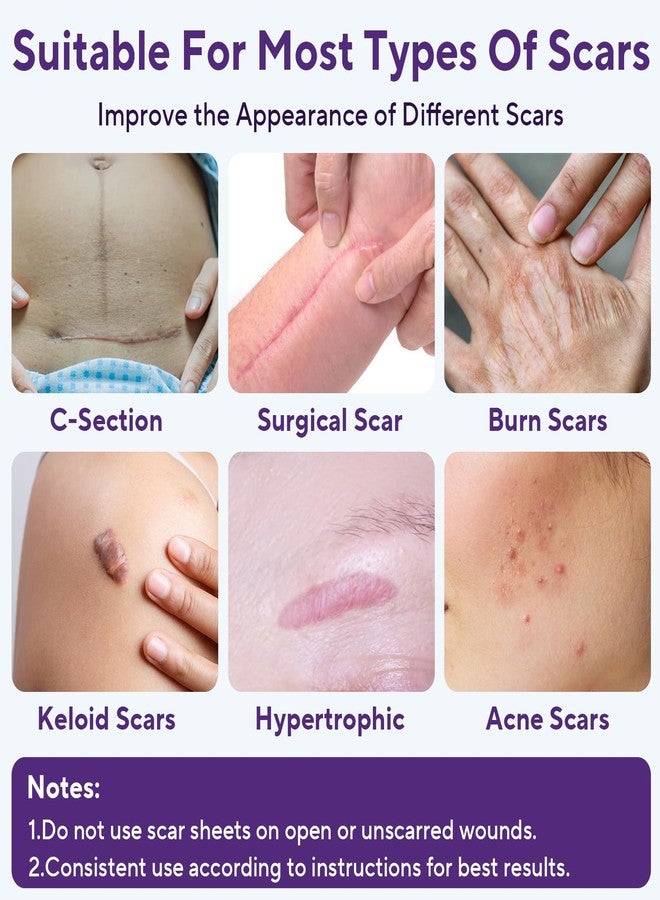 ZETRALL Silicone Scar Sheets, Silicone Scar Tape (1.6"x 60" Roll-1.5m, Advanced Scars Strips for Surgical, C-Section, Tummy Tuck, Burn, Hypertrophic, Keloid Bump Removal Treatment, Reusable - Image 2